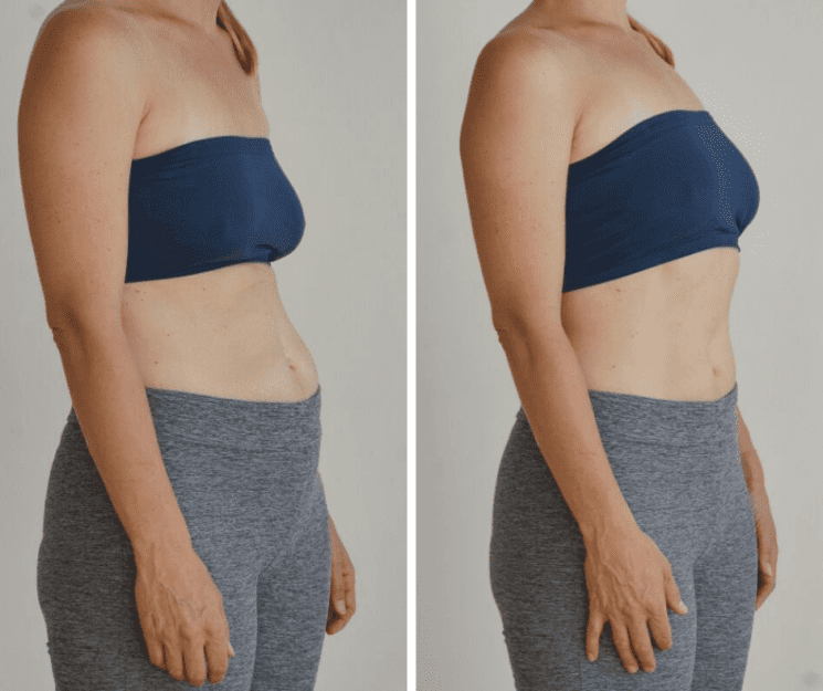 Rektusdiastase nach der Geburt: Ursachen, Symptome und Übungen 9 richtiges Bauchmuskeltraining mit Rektusdiastase